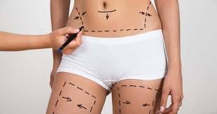 How Many Sessions Are Needed for Liposuction in Islamabad?
